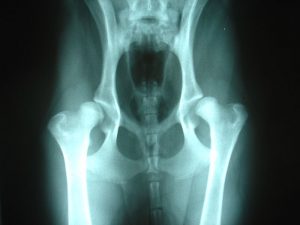 800px-bilateral_hip_dysplasia